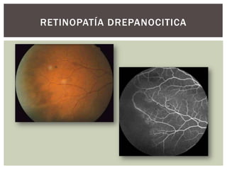 RETINOPATÍA DREPANOCITICA
 