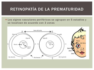  Los signos vasculares periféricos se agrupan en 5 estadios y
se localizan de acuerdo con 3 zonas
RETINOPATÍA DE LA PREMATURIDAD
 