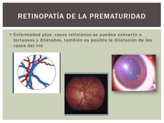  Enfermedad plus: vasos retinianos se pueden convertir a
tortuosos y dilatados, también es posible la dilatación de los
vasos del iris
RETINOPATÍA DE LA PREMATURIDAD
 