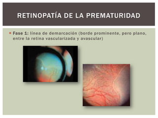  Fase 1: línea de demarcación (borde prominente, pero plano,
entre la retina vascularizada y avascular)
RETINOPATÍA DE LA PREMATURIDAD
 