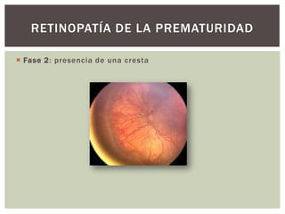  Fase 2: presencia de una cresta
RETINOPATÍA DE LA PREMATURIDAD
 