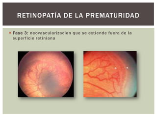  Fase 3: neovascularizacion que se extiende fuera de la
superficie retiniana
RETINOPATÍA DE LA PREMATURIDAD
 