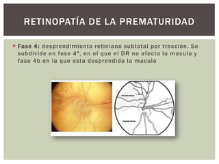  Fase 4: desprendimiento retiniano subtotal por tracción. Se
subdivide en fase 4ª, en el que el DR no afecta la macula y
fase 4b en la que esta desprendida la macula
RETINOPATÍA DE LA PREMATURIDAD
 