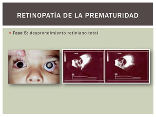  Fase 5: desprendimiento retiniano total
RETINOPATÍA DE LA PREMATURIDAD
 