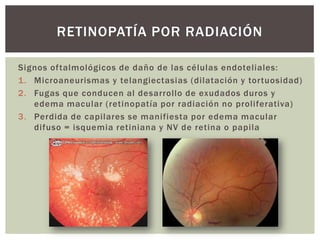 Signos oftalmológicos de daño de las células endoteliales:
1. Microaneurismas y telangiectasias (dilatación y tortuosidad)
2. Fugas que conducen al desarrollo de exudados duros y
edema macular (retinopatía por radiación no proliferativa)
3. Perdida de capilares se manifiesta por edema macular
difuso = isquemia retiniana y NV de retina o papila
RETINOPATÍA POR RADIACIÓN
 