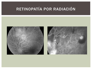 RETINOPATÍA POR RADIACIÓN
 
