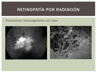 Tratamiento- fotocoagulación con laser
RETINOPATÍA POR RADIACIÓN
 