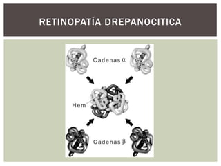RETINOPATÍA DREPANOCITICA
 