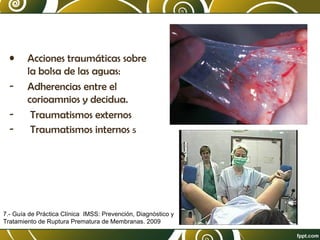 •
-

Acciones traumáticas sobre
la bolsa de las aguas:
Adherencias entre el
corioamnios y decidua.
Traumatismos externos
Traumatismos internos 5

7.- Guía de Práctica Clínica IMSS: Prevención, Diagnóstico y
Tratamiento de Ruptura Prematura de Membranas. 2009

 