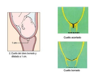 Cuello acortado
Cuello borrado
 