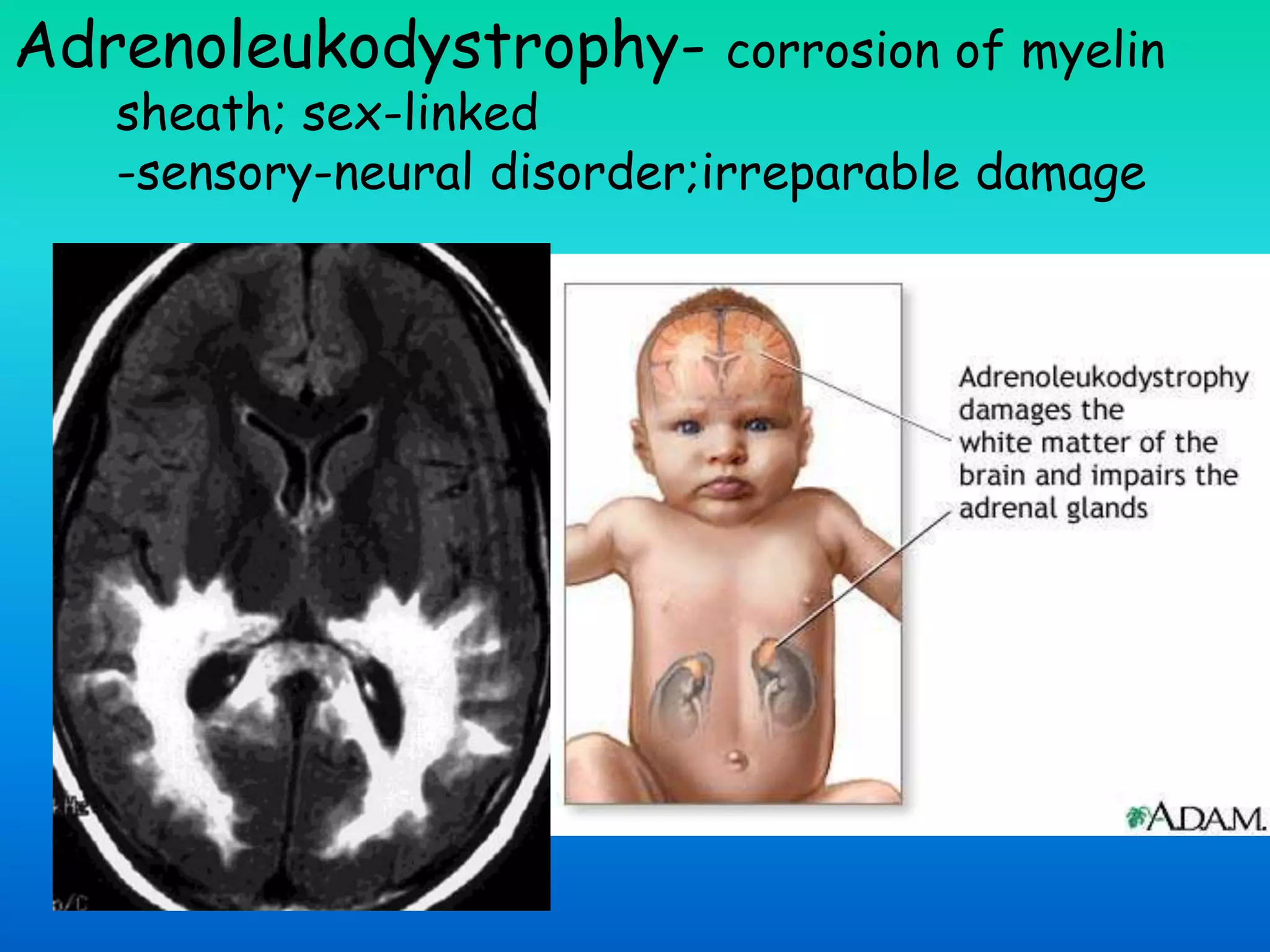 Adrenoleukodystrophy- corrosion of myelin
sheath; sex-linked
-sensory-neural disorder;irreparable damage
 