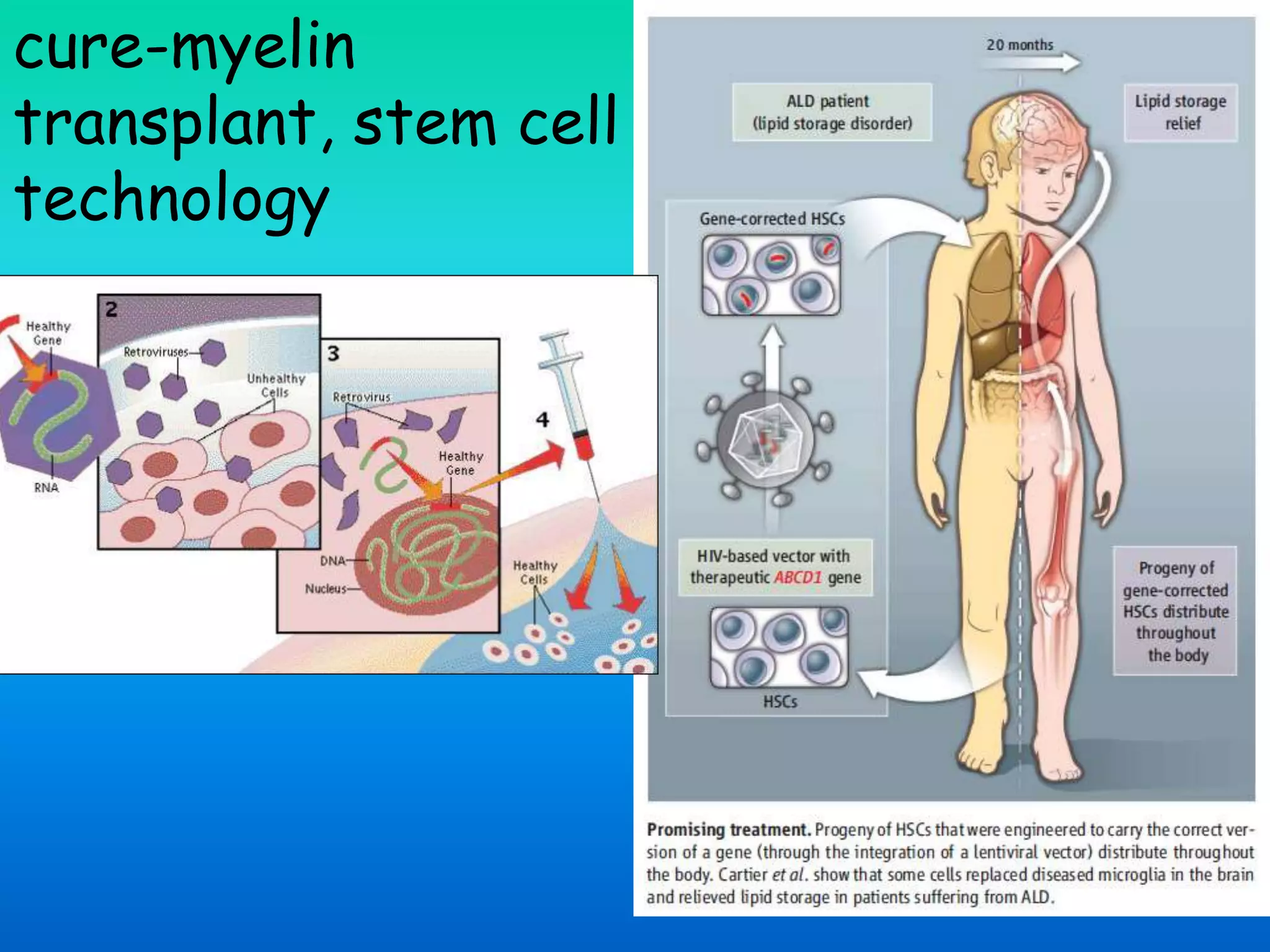 cure-myelin
transplant, stem cell
technology
 