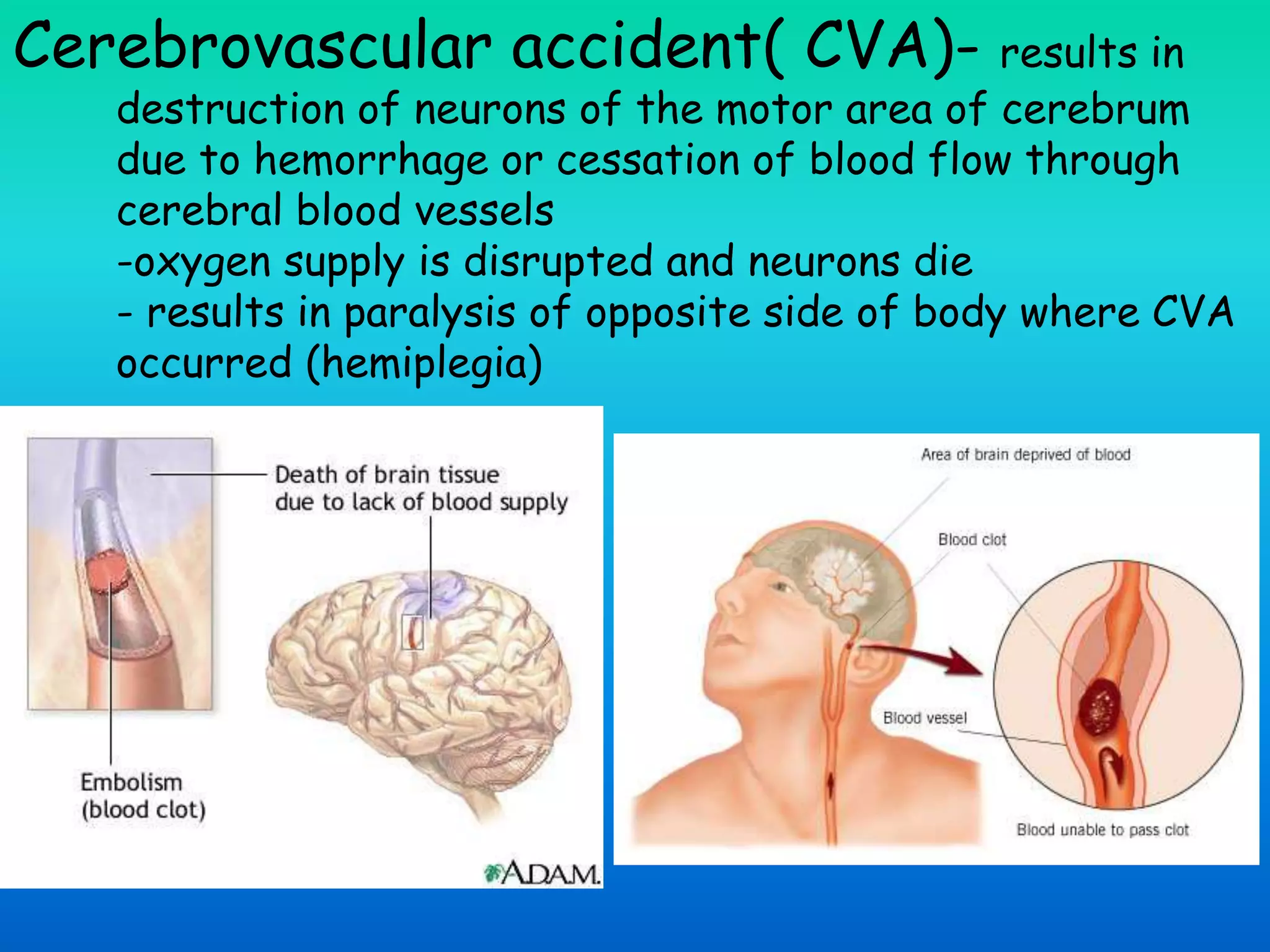 Cerebrovascular accident( CVA)- results in
destruction of neurons of the motor area of cerebrum
due to hemorrhage or cessation of blood flow through
cerebral blood vessels
-oxygen supply is disrupted and neurons die
- results in paralysis of opposite side of body where CVA
occurred (hemiplegia)
 