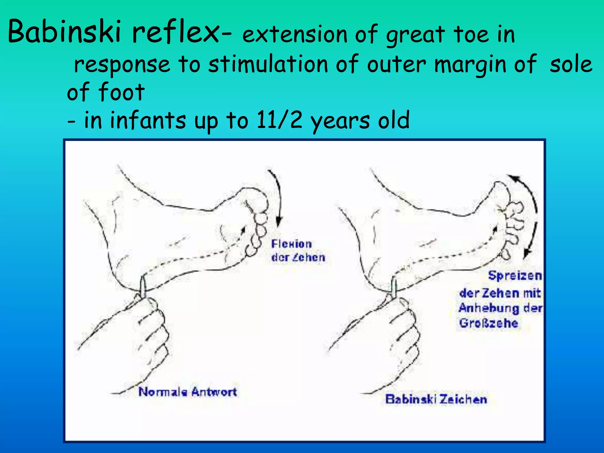 Babinski reflex- extension of great toe in
response to stimulation of outer margin of sole
of foot
- in infants up to 11/2 years old
 
