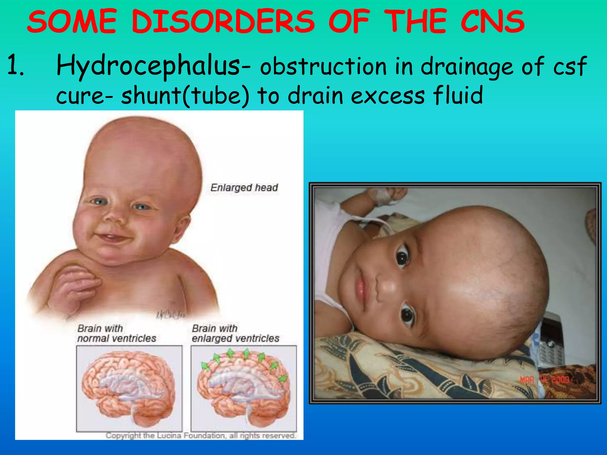 SOME DISORDERS OF THE CNS
1. Hydrocephalus- obstruction in drainage of csf
cure- shunt(tube) to drain excess fluid
 