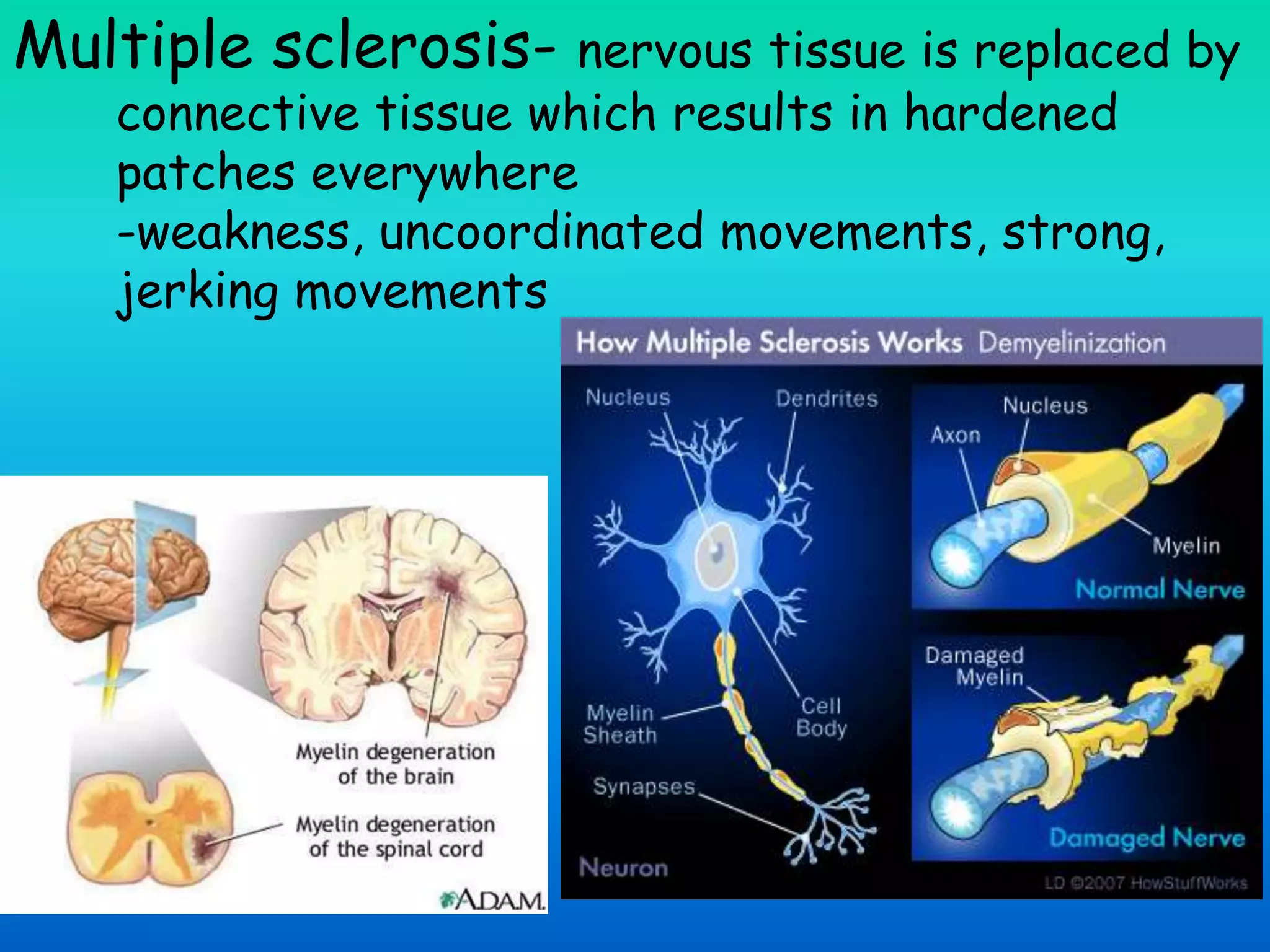 Multiple sclerosis- nervous tissue is replaced by
connective tissue which results in hardened
patches everywhere
-weakness, uncoordinated movements, strong,
jerking movements
 