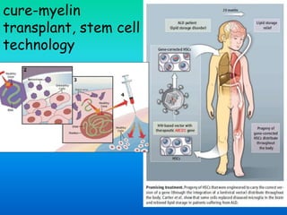 cure-myelin
transplant, stem cell
technology
 