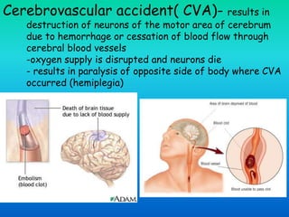 Cerebrovascular accident( CVA)- results in
destruction of neurons of the motor area of cerebrum
due to hemorrhage or cessation of blood flow through
cerebral blood vessels
-oxygen supply is disrupted and neurons die
- results in paralysis of opposite side of body where CVA
occurred (hemiplegia)
 