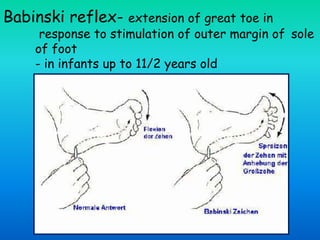 Babinski reflex- extension of great toe in
response to stimulation of outer margin of sole
of foot
- in infants up to 11/2 years old
 