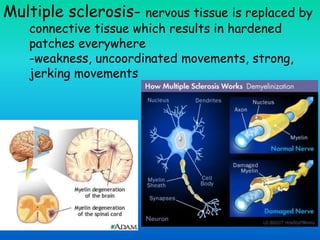 Multiple sclerosis- nervous tissue is replaced by
connective tissue which results in hardened
patches everywhere
-weakness, uncoordinated movements, strong,
jerking movements
 