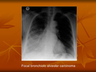 Focal bronchiolo alveolar carcinoma
 