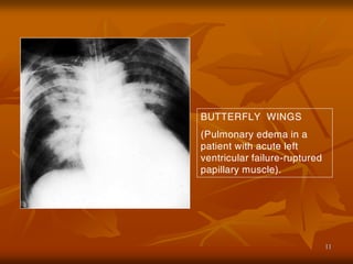 11
BUTTERFLY WINGS
(Pulmonary edema in a
patient with acute left
ventricular failure-ruptured
papillary muscle).
 