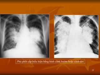 12
Phù phổi cấp biểu hiện bằng hình cánh bƣớm hoặc cánh dơi
 