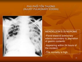 18
PHUØ PHOÅI TOÅN THÖÔNG
(INJURY PULMONARY EDEMA)
MENDELSON’S SYNDROME
-Florid bilateral pulmonary
edema secondary to aspiration
of gastric contents.
-Appearing within 24 hours of
the incident.
-The mortality is high.
 
