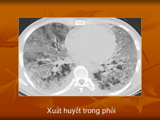 Xuất huyết trong phổi
 