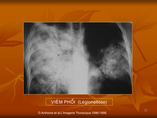 21
D.Anthoine et al.L’Imagerie Thoracique.1996-1998.
VIEÂM PHOÅI (Leùgionellose)
 