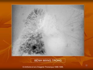 22
D.Anthoine et al.L’Imagerie Thoracique.1996-1998.
BEÄNH MAØNG TRONG
 
