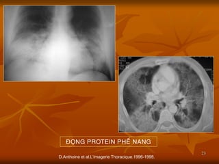 23
D.Anthoine et al.L’Imagerie Thoracique.1996-1998.
ÑOÏNG PROTEIN PHEÁ NANG
 