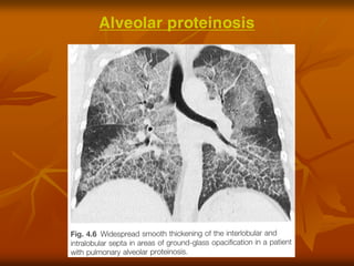 Alveolar proteinosis
 