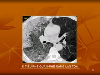 25
K TIEÅU PHEÁ QUAÛN-PHEÁ NANG LAN TOÛA
 