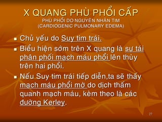 27
X QUANG PHUØ PHOÅI CAÁP
PHUØ PHOÅI DO NGUYEÂN NHAÂN TIM
(CARDIOGENIC PULMONARY EDEMA)
 Chuû yeáu do Suy tim traùi.
 Bieåu hieän sôùm treân X quang laø söï taùi
phaân phoái maïch maùu phoåi leân thuøy
treân hai phoåi.
 Neáu Suy tim traùi tieáp dieãn,ta seõ thaáy
maïch maùu phoåi môø do dòch thaám
quanh maïch maùu, keøm theo laø caùc
ñöôøng Kerley.
 