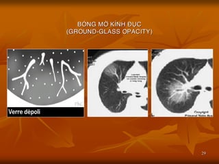 29
BOÙNG MÔØ KÍNH ÑUÏC
(GROUND-GLASS OPACITY)
 