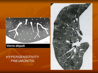 HYPERSENSITIVITY
PNEUMONITIS
 