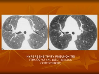 HYPERSENSITIVITY PNEUNONITIS
(TRƢỚC VÀ SAU ĐiỀU TRỊ BẰNG
CORTISTEROID)
 