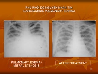 33
PHUØ PHOÅI DO NGUYEÂN NHAÂN TIM
(CARDIOGENIC PULMONARY EDEMA)
PULMONARY EDEMA /
MITRAL STENOSIS
AFTER TREATMENT
 