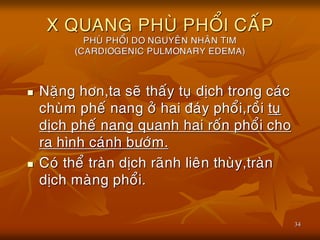 34
X QUANG PHUØ PHOÅI CAÁP
PHUØ PHOÅI DO NGUYEÂN NHAÂN TIM
(CARDIOGENIC PULMONARY EDEMA)
 Naëng hôn,ta seõ thaáy tuï dòch trong caùc
chuøm pheá nang ôû hai ñaùy phoåi,roài tuï
dòch pheá nang quanh hai roán phoåi cho
ra hình caùnh böôùm.
 Coù theå traøn dòch raõnh lieân thuøy,traøn
dòch maøng phoåi.
 