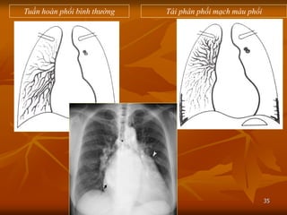 35
Tuần hoàn phổi bình thường Tái phân phối mạch máu phổi
 