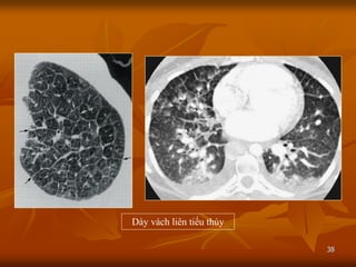 38
Dày vách liên tiểu thùy
 