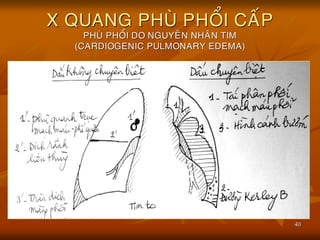 40
X QUANG PHUØ PHOÅI CAÁP
PHUØ PHOÅI DO NGUYEÂN NHAÂN TIM
(CARDIOGENIC PULMONARY EDEMA)
 