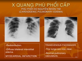 41
X QUANG PHUØ PHOÅI CAÁP
PHUØ PHOÅI DO NGUYEÂN NHAÂN TIM
(CARDIOGENIC PULMONARY EDEMA)
-Redistribution.
-Diffuse bilateral interstitial
edema.
MYOCARDIAL INFARCTION
TRANSVENOUS PACEMAKER
-The lungs are now clear.
-Normal pulmonary
vasculature.
 