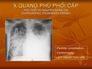 42
X QUANG PHUØ PHOÅI CAÁP
PHUØ PHOÅI DO NGUYEÂN NHAÂN TIM
(CARDIOGENIC PULMONARY EDEMA)
-Perihilar consolidation.
-Cardiomegaly.
LEFT HEART FAILURE
 