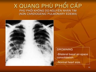 46
X QUANG PHUØ PHOÅI CAÁP
PHUØ PHOÅI KHOÂNG DO NGUYEÂN NHAÂN TIM
(NON CARDIOGENIC PULMONARY EDEMA)
DROWNING
-Bilateral basal air-space
consolidation.
-Normal heart size.
 