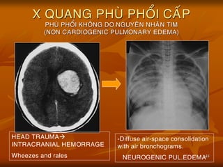 48
X QUANG PHUØ PHOÅI CAÁP
PHUØ PHOÅI KHOÂNG DO NGUYEÂN NHAÂN TIM
(NON CARDIOGENIC PULMONARY EDEMA)
-Diffuse air-space consolidation
with air bronchograms.
NEUROGENIC PUL.EDEMA
HEAD TRAUMA
INTRACRANIAL HEMORRAGE
Wheezes and rales
 