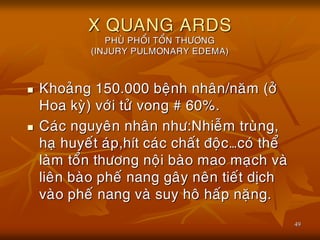 49
X QUANG ARDS
PHUØ PHOÅI TOÅN THÖÔNG
(INJURY PULMONARY EDEMA)
 Khoaûng 150.000 beänh nhaân/naêm (ôû
Hoa kyø) vôùi töû vong # 60%.
 Caùc nguyeân nhaân nhö:Nhieãm truøng,
haï huyeát aùp,hít caùc chaát ñoäc…coù theå
laøm toån thöông noäi baøo mao maïch vaø
lieân baøo pheá nang gaây neân tieát dòch
vaøo pheá nang vaø suy hoâ haáp naëng.
 