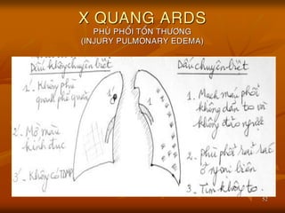 52
X QUANG ARDS
PHUØ PHOÅI TOÅN THÖÔNG
(INJURY PULMONARY EDEMA)
 