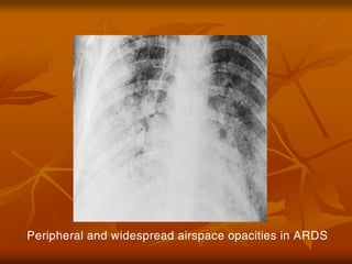 Peripheral and widespread airspace opacities in ARDS
 